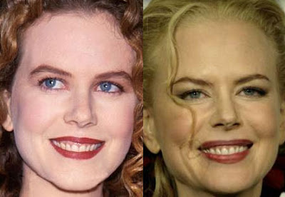 Nicole Kidman Plastic Surgery Before And After