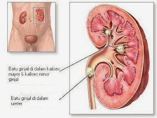 cara alami mengobati batu ginjal