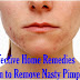 10 Effective Home Remedies Proven to Remove Nasty Pimples