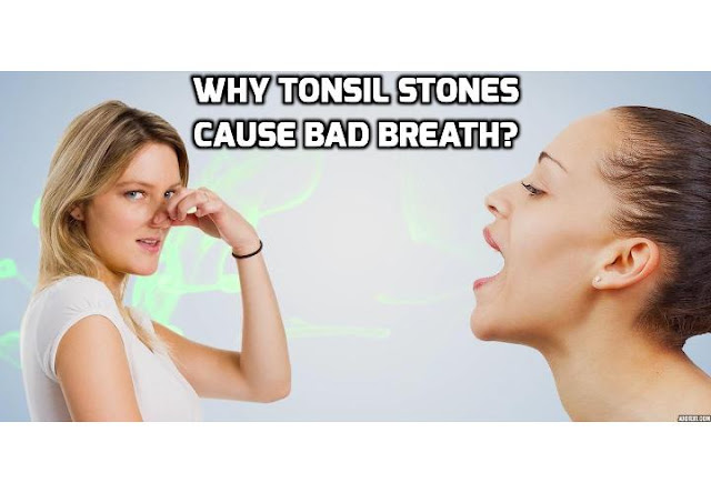 Most individuals who suffer from tonsil stones do not experience serious medical symptoms. However, some patients develop tonsil stones bad breath that can impact their lifestyle and sense of wellbeing significantly. 