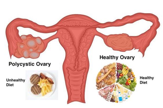 pcos