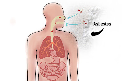  Asbestos and the Risk of Peritoneal Mesothelioma
