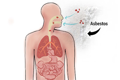  Asbestos and the Risk of Peritoneal Mesothelioma