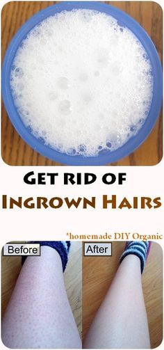 Get rid of ingrown hairs