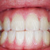 How to Cure Gum Disease Without a Dentist?