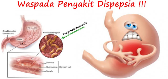 cara menyembuhkan dispepsia