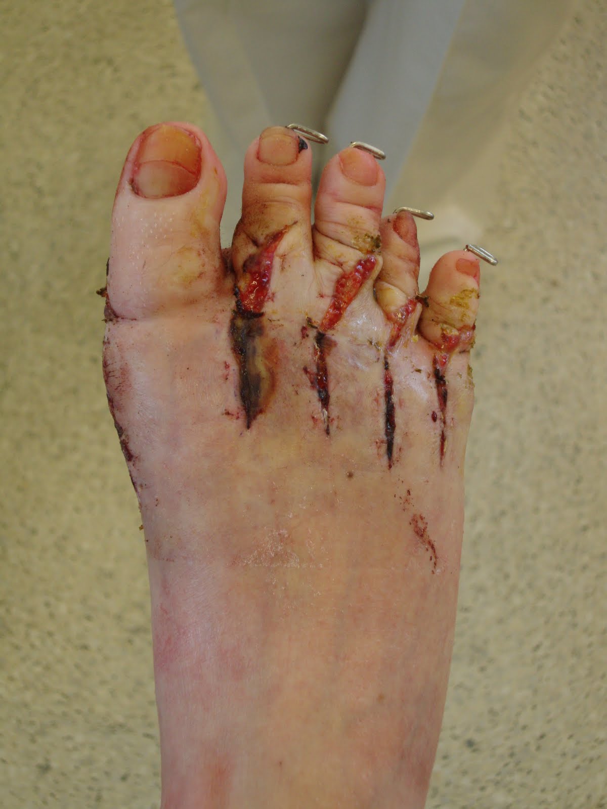 Gwen's Feet (and Hand): Having Fifty-Five Stitches Out Hurts!