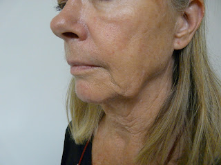 What are Jowls, Causes, Prevention, How to Get Rid of Them ...