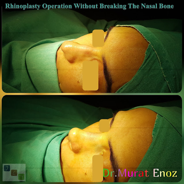 Nose job without bone broken,Rhinoplasty Without Breaking The Nasal Bone in Istanbul,