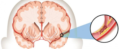 cara menyembuhkan penyakit stroke, berapa lama penyakit stroke bisa sembuh, cara menyembuhkan penyakit stroke dengan cepat, pengobatan penyakit stroke, cara mencegah penyakit stroke, ciri ciri penyakit stroke, penyakit stroke pdf, cara mengatasi penyakit stroke, pengertian penyakit stroke, penyakit stroke adalah, makalah penyakit stroke, penyebab penyakit stroke, penyakit stroke ringan, cara mengobati penyakit stroke, gejala penyakit stroke, buah untuk penyakit stroke, apa itu penyakit stroke, tentang penyakit stroke, apa penyebab penyakit stroke, ppt penyakit stroke, gambar penyakit stroke, makalah tentang penyakit stroke, penyakit stroke dan pengobatannya, makanan untuk penyakit stroke, ciri penyakit stroke, jurnal penyakit stroke, jurnal tentang penyakit stroke, pathway penyakit stroke, definisi penyakit stroke, patofisiologi penyakit stroke, penyakit stroke, penyakit stroke pdf, penyakit stroke hemoragik, penyakit stroke dalam bahasa inggris, penyakit stroke iskemik, penyakit stroke berat, penyakit stroke otak, penyakit stroke dalam islam, penyakit stroke ringan, penyakit stroke di indonesia, penyakit stroke ppt, penyakit stroke menurut islam, penyakit stroke dan pencegahannya, penyakit stroke non hemoragik, penyakit stroke bisa sembuh total, penyakit stroke adalah pdf, penyakit stroke apakah bisa sembuh, penyakit stroke menurut who, penyakit stroke wikipedia, penyakit stroke boleh dipijat, penyakit stroke sebelah kanan, penyakit stroke adalah, penyakit stroke akibat apa, penyakit stroke akut, penyakit stroke apa itu, stroke penyakit apa, obat penyakit stroke alami, penyakit stroke pada anak, penyakit stroke menurut para ahli, penyakit yang mengakibatkan stroke adalah, cara menyembuhkan penyakit stroke alami, cara mengobati penyakit stroke alami, askep penyakit stroke, apakah penyakit stroke bisa sembuh total, penyakit yang dapat mengakibatkan stroke adalah, pengobatan penyakit stroke secara alami, arti penyakit stroke, apakah penyakit stroke ringan bisa sembuh total, apakah penyakit stroke menular, penyakit stroke batang otak, penyakit stroke bertahan berapa lama, penyakit stroke berdarah, penyakit stroke boleh sembuh, penyakit stroke berulang, penyakit stroke boleh diurut, gejala penyakit stroke berat, penyebab penyakit stroke biologi, penyakit stroke tidak bisa bicara, apakah penyakit stroke bisa menular, penyakit stroke setengah badan, penyakit stroke apa boleh dipijat, mengapa penyakit stroke bisa terjadi, apakah penyakit stroke bisa diobati, penyakit stroke.com, penyakit stroke dan cara penyembuhannya, penyakit stroke dan cara pengobatannya, penyakit stroke dan cara pencegahannya, agar penyakit stroke cepat sembuh, penyakit stroke dan cara mengobatinya, penyakit stroke dan cara mengatasinya, www.obat penyakit stroke.com, ciri penyakit stroke, ciri penyakit stroke ringan, penyebab penyakit stroke dan cara pengobatannya, ciri2 penyakit stroke ringan, cegah penyakit stroke, penyebab penyakit stroke dan cara mencegahnya, penyebab penyakit stroke dan cara penyembuhannya, contoh penyakit stroke, cara penyakit stroke, cerita penyakit stroke, gejala penyakit stroke dan cara penyembuhannya, penyakit stroke disebabkan oleh, penyakit stroke dapat disebabkan oleh tekanan darah tinggi yang menyebabkan, penyakit stroke disebabkan penyumbatan pembuluh nadi di, penyakit stroke dalam pandangan islam, penyakit stroke dapat disebabkan oleh tekanan darah tinggi yang menyebabkan brainly, penyakit stroke di wajah, penyakit stroke dapat terjadi apabila jumlah lemak dalam tubuh berlebih khususnya kolesterol, penyakit stroke dan obatnya, penyakit stroke dan penyembuhannya, penyakit stroke di usia muda, penyakit stroke dapat disembuhkan, penyakit stroke dalam al quran, penyakit stroke dalam bahasa mandarin, penyakit stroke di malaysia, penyakit stroke dan penanganannya, penyakit stroke, faktor penyakit stroke, fisioterapi penyakit stroke, foto penyakit stroke, fase penyakit stroke, farmakologi penyakit stroke, fakta penyakit stroke, farmakoterapi penyakit stroke, frekuensi penyakit stroke, fenomena penyakit stroke di indonesia, fisiologi penyakit stroke, patofisiologi penyakit stroke, penyakit stroke gejala, penyakit stroke dan gejalanya, obat penyakit gejala stroke, gejala penyakit stroke ringan, gambar penyakit stroke, gejala penyakit stroke dan pengobatannya, cara menyembuhkan penyakit gejala stroke, gejala penyakit stroke pdf, genogram penyakit stroke, guideline penyakit stroke, gangguan penyakit stroke, gambaran penyakit stroke, gejala penyakit stroke dan pengobatan, grafik penyakit stroke, hubungan penyakit stroke dengan gizi, obat untuk penyakit gejala stroke, obat tradisional penyakit gejala stroke, penyakit stroke hemorrhagic, penyakit stroke hemoragik pdf, penyakit hemoragik stroke, penyakit heat stroke, penyakit heat stroke pdf, perjalanan penyakit stroke hemoragik, obat penyakit stroke herbal, askep penyakit stroke hemoragik, penyebab penyakit stroke hemoragik, jurnal penyakit stroke hemoragik, makalah penyakit stroke hemoragik, pengobatan penyakit stroke hemoragik, epidemiologi penyakit stroke hemoragik, komplikasi penyakit stroke hemoragik, pencegahan penyakit stroke hemoragik, patofisiologi penyakit stroke hemoragik, intervensi penyakit stroke hemoragik, penyakit stroke non hemorrhagic, penyakit stroke in english, penyakit stroke infark, penyakit stroke itu apa, apakah penyakit stroke itu, jurnal penyakit stroke iskemik, apakah penyakit stroke itu keturunan, penyakit stroke wikipedia indonesia, intervensi penyakit stroke, info penyakit stroke, identifikasi penyakit stroke, prevalensi penyakit stroke di indonesia, data penyakit stroke di indonesia, indikasi penyakit stroke, implementasi penyakit stroke, istilah penyakit stroke, perkembangan penyakit stroke di indonesia, penyakit stroke jantung tidak dijamin bpjs, penyakit stroke jurnal, penyakit stroke jantung, penyakit stroke dan jantung, jenis penyakit stroke, jurnal penyakit stroke pdf, jenis penyakit stroke dan pengobatannya, jelaskan penyakit stroke, jamu penyakit stroke, jenis2 penyakit stroke, penyebab penyakit stroke dan jantung, jurnal penyakit stroke di indonesia, data penyakit stroke di jawa barat, jumlah penyakit stroke di indonesia, jurnal penyakit stroke pada lansia, perbedaan penyakit stroke dan jantung, penyakit stroke kiri, penyakit stroke karena diabetes, penyakit stroke kecil, penyakit stroke kanan, penyakit stroke keturunan, penyakit stroke kaskus, penyakit stroke koma, penyakit stroke pada kucing, penyakit stroke terjadi karena, jelaskan penyakit kelainan stroke, komplikasi penyakit stroke, klasifikasi penyakit stroke, kasus penyakit stroke, konsep penyakit stroke, kesimpulan penyakit stroke, kode penyakit stroke, kuesioner penyakit stroke, konsultasi penyakit stroke, kesembuhan penyakit stroke, penyakit stroke layak terbang menurut iata, penyakit stroke lumpuh sebelah kiri, penyakit stroke lumpuh, penyakit stroke lidah, penyakit stroke pada lansia, makalah tentang penyakit stroke lengkap, penyakit stroke pada usia lanjut, leaflet penyakit stroke, lp penyakit stroke, larangan penyakit stroke, lama penyakit stroke, makalah penyakit stroke pada lansia, askep penyakit stroke pada lansia, leaflet penyakit stroke pdf, penyebab penyakit stroke pada lansia, lamanya penyakit stroke, latihan penyakit stroke, penyakit stroke menurut ustad danu, penyakit stroke mata, penyakit stroke muka, penyakit stroke makalah, penyakit stroke mematikan, penyakit stroke merupakan, penyakit stroke multiple sclerosis, penyakit stroke mati sebelah, penyakit stroke mulut, penyakit stroke meninggal, penyakit mirip stroke, penyakit minor stroke, penyakit mini stroke, penyebab penyakit stroke menurut ustad danu, pengertian penyakit stroke menurut who, pengertian penyakit stroke menurut para ahli, perjalanan penyakit stroke non hemoragik, pencegahan penyakit stroke non hemoragik, epidemiologi penyakit stroke non hemoragik, askep penyakit stroke non hemoragik, patofisiologi penyakit stroke non hemoragik, latar belakang penyakit stroke non hemoragik, asuhan keperawatan penyakit stroke non hemoragik, penyakit stroke yang sering nangis, ncp penyakit stroke, nama penyakit stroke, nama penyakit stroke ringan, penyakit stroke obatnya, penyakit stroke obat, penyakit stroke obatnya apa, penyakit stroke pendarahan otak, obat penyakit stroke ringan, obat penyakit stroke tradisional, obat penyakit stroke darah tinggi, obat penyakit stroke berat, obat penyakit stroke 5, operasi penyakit stroke, obat penyakit stroke dari tumbuhan, olahraga penyakit stroke, obat penyakit stroke menurut islam, penyakit stroke parah, penyakit stroke powerpoint, penyakit stroke ppt download, penyakit stroke pembuluh darah pecah, penyakit stroke penyebabnya, penyakit stroke panas, penyakit stroke parkinson, penyakit pasca stroke, penyakit stroke dan pengobatannya, makalah penyakit stroke pdf, epidemiologi penyakit stroke pdf, definisi penyakit stroke pdf, penyakit stroke ringan dan berat, penyebab penyakit stroke ringan, penyembuhan penyakit stroke ringan, terapi penyakit stroke ringan, tanda penyakit stroke ringan, tentang penyakit stroke ringan, pantangan penyakit stroke ringan, penanganan penyakit stroke ringan, pencegahan penyakit stroke ringan, mengatasi penyakit stroke ringan, penyakit stroke akibat rokok, apakah penyakit stroke ringan bisa sembuh, menghilangkan penyakit stroke ringan, cara mengobati penyakit stroke ringan, penyakit stroke susah tidur, penyakit seperti stroke, penyakit saraf stroke, penyakit sejenis stroke, pengobatan penyakit stroke secara medis, pengobatan penyakit stroke secara tradisional, bisakah penyakit stroke sembuh, penyembuhan penyakit stroke secara alami, cara mengobati penyakit stroke secara alami, cara mengobati penyakit stroke secara tradisional, cara mencegah penyakit stroke sejak dini, cara penyembuhan penyakit stroke secara alami, sap penyakit stroke, sejarah penyakit stroke, simptom penyakit stroke, penyakit stroke tidak bisa tidur, penyakit stroke tenggorokan, penyakit stroke telinga, penyakit stroke tia, stroke penyakit turunan, penyakit tentang stroke, obat penyakit stroke terbaik, penyakit stroke dan darah tinggi, terapi penyakit stroke, tingkatan penyakit stroke, tahapan penyakit stroke, penyakit stroke usia muda, penyakit stroke ustad danu, penyakit stroke pada usia muda, penyakit stroke ala ustad danu, ubat penyakit stroke, urutan penyakit stroke, urut penyakit stroke, usia penyakit stroke, video penyakit stroke, vidio penyakit stroke, penyakit jantung dan stroke, penyakit stroke wajah, penyakit stroke wiki, pengertian penyakit stroke wikipedia, penyakit stroke pada wajah, penyakit stroke pada wanita, www.penyakit stroke, woc penyakit stroke, data penyakit stroke menurut who, prevalensi penyakit stroke menurut who, penyakit stroke youtube, mengobati penyakit stroke yang paling efisien, patofisiologi penyakit stroke pdf, penyebab penyakit stroke pdf, pencegahan penyakit stroke pdf, pengobatan penyakit stroke pdf, diet penyakit stroke pdf, etiologi penyakit stroke pdf, diagnosis penyakit stroke pdf, penyakit stroke iskemik pdf, penatalaksanaan penyakit stroke pdf, pengertian penyakit stroke pdf, penanganan penyakit stroke pdf, diagnosa penyakit stroke pdf, artikel penyakit stroke pdf, perjalanan penyakit stroke pdf, artikel tentang penyakit stroke pdf, askep penyakit stroke pdf, pharmaceutical care untuk penyakit stroke pdf, tanda dan gejala penyakit stroke pdf, jurnal epidemiologi penyakit stroke pdf, faktor risiko penyakit stroke pdf, faktor resiko penyakit stroke pdf, jurnal tentang penyakit stroke pdf, jurnal kesehatan penyakit stroke pdf, komplikasi penyakit stroke pdf, laporan pendahuluan penyakit stroke pdf, makalah tentang penyakit stroke pdf, penelitian penyakit stroke pdf, pdf tentang penyakit stroke, asuhan keperawatan penyakit stroke hemoragik, latar belakang penyakit stroke hemoragik, laporan pendahuluan penyakit stroke hemoragik, pengertian penyakit stroke hemoragik, pengertian penyakit stroke non hemoragik, penyebab penyakit stroke iskemik, perjalanan penyakit stroke iskemik, pengertian penyakit stroke iskemik, patofisiologi penyakit stroke iskemik, penyembuhan penyakit stroke berat, cara mengobati penyakit stroke berat, obat untuk penyakit stroke berat, ciri-ciri penyakit stroke berat, obat tradisional penyakit stroke berat, obat herbal untuk penyakit stroke berat, obat herbal penyakit stroke berat, penyebab penyakit stroke dalam islam, penyebab penyakit stroke menurut islam, buah untuk penyakit stroke ringan, obat herbal penyakit stroke ringan, makanan untuk penyakit stroke ringan, akibat penyakit stroke ringan, obat alami penyakit stroke ringan, apa itu penyakit stroke ringan, cara mengobati penyakit stroke ringan secara alami, apa penyebab penyakit stroke ringan, cara alami mengobati penyakit stroke ringan, berapa lama penyakit stroke ringan sembuh, cara penyembuhan penyakit stroke ringan, cara terapi penyakit stroke ringan, obat herbal untuk penyakit stroke ringan, mengobati penyakit stroke ringan, mencegah penyakit stroke ringan, menyembuhkan penyakit stroke ringan, pantangan makanan penyakit stroke ringan, obat tradisional penyakit stroke ringan, obat tradisional untuk penyakit stroke ringan, tanaman obat untuk penyakit stroke ringan, pengobatan penyakit stroke ringan, tips penyembuhan penyakit stroke ringan, ramuan tradisional untuk penyakit stroke ringan, tanda2 penyakit stroke ringan, terapi untuk penyakit stroke ringan, obat untuk penyakit stroke ringan, persentase penyakit stroke di indonesia, epidemiologi penyakit stroke di indonesia, kebijakan penyakit stroke di indonesia, angka kejadian penyakit stroke di indonesia, jumlah penderita penyakit stroke di indonesia, stroke di indonesia.pdf, data statistik penyakit stroke di indonesia, stroke di indonesia tahun 2014, stroke di indonesia tahun 2015, penyuluhan penyakit stroke ppt, ppt tentang penyakit stroke, sakit stroke menurut islam, sakit stroke dalam islam, gejala penyakit stroke dan pencegahannya, penyebab penyakit stroke dan pencegahannya, penyebab penyakit stroke dan pengobatannya, stroke non hemoragik adalah, stroke non hemoragik adalah pdf, stroke non hemoragik askep, stroke non hemoragik doc, stroke non hemoragik dengan diabetes melitus, stroke non hemoragik faktor risiko, stroke non hemoragik icd 10, stroke non hemoragik jurnal, stroke non hemoragik kasus, stroke non hemoragik lp, stroke non hemoragik menurut who, stroke non hemoragik pdf, stroke non hemoragik ppt, stroke non hemoragik patofisiologi, stroke non hemoragik ppt scribd, stroke non hemoragik pathway, stroke non hemoragik pada lansia, stroke non hemoragik referat, stroke non hemoragik scribd, stroke non hemoragik terapi, stroke non hemoragik usu, stroke non hemoragik wikipedia, apa penyakit stroke bisa sembuh total, penyakit stroke apa bisa sembuh, apakah penyakit stroke boleh dipijat, cara menyembuhkan penyakit stroke sebelah kanan, penyebab penyakit stroke adalah, penyakit stroke apa bisa disembuhkan, penyakit stroke bisa disembuhkan, penyakit stroke dan penjelasannya, penyakit stroke doc, penyakit stroke dan penyebab, penyakit stroke diakibatkan, penyakit stroke darah, penyakit heat stroke adalah, penyakit stroke akibat merokok, penyakit stroke pada manusia, penyakit stroke pada manula, penyakit stroke pada remaja, penyakit stroke sebelah kiri, penyakit yang dapat menyebabkan stroke adalah, apa akibat dari penyakit stroke, cara menyembuhkan penyakit stroke akut, apa sih penyakit stroke itu, penyakit stroke akibat, penyakit stroke apa obatnya