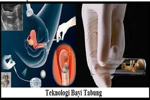 teknologi bayi tabung