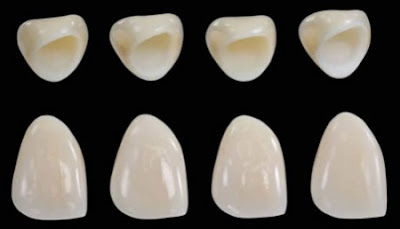 Bọc răng sứ Zirconia có tốt không?