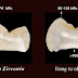 Có nên bọc răng sứ Zirconia không?