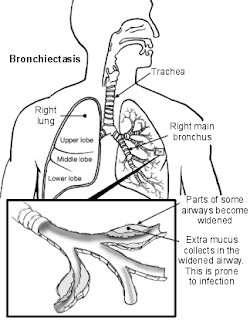 Nursing Care Plan for Bronchiectasis