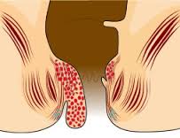Bagaimana cara mengobati penyakit wasir secara alami pada wasir kronis