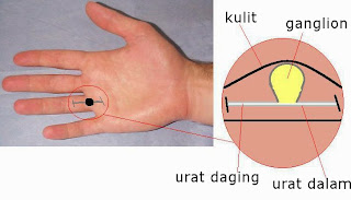 benjolan ganglion