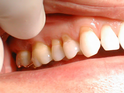 Cách xử lý răng bị ê buốt