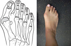 bunion