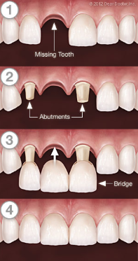 retainer dan gigi palsu