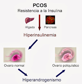 Consecuencias de la Resistencia a la insulina sobre el hiperandrogenismo y los ovarios poliquísticos