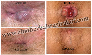 Obat Wasir Ambeien