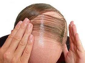 obat penumbuh rambut alami
