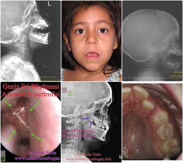 The Effects of Enlarged Adenoids on Dentofacial Developments - Adenoid Hypertrophy and Its Negative Health Effects Depending on the adenoid hypertrophy in children, the following changes may occur in the jaw and tooth structure - The Mouth Breathing Syndrome (MBS) - How to Evaluate the Size of The Adenoid? - Adenoid graphy (lateral cephalometic radiograph) - How should the lateral cephalometic radiograph be? - How Should Treatment Be Berformed in Patients With Changes in The Jaw and Tooth Structure Due to Adenoid Hypertrophy? - When Does Adenoid Growth Stop Spontaneously? - Don't Wait To Structural Change For Treatment of Severe Adenoid Hypertrophy! -
