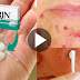 Wow, See How To Remove Acne, Pimples, And Scars With The Help Of Aspirin!