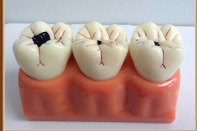 Điều trị tủy răng cần biết