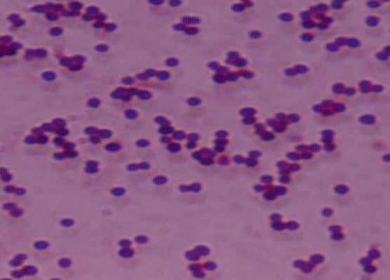 Drug resistance of Staphylococcus aureus in sinusitis patients