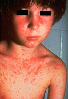 Red rough rash on the body caused due to the German measles disease pictures