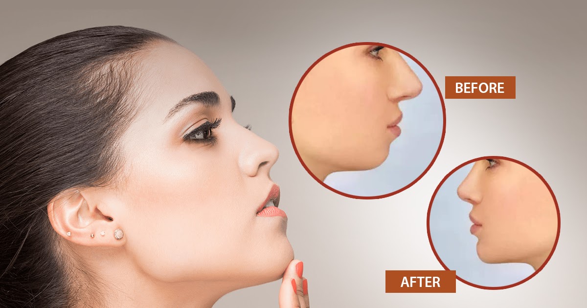 Anew Aesthetic Daycare: Top Reasons to Consider Chin Augmentation