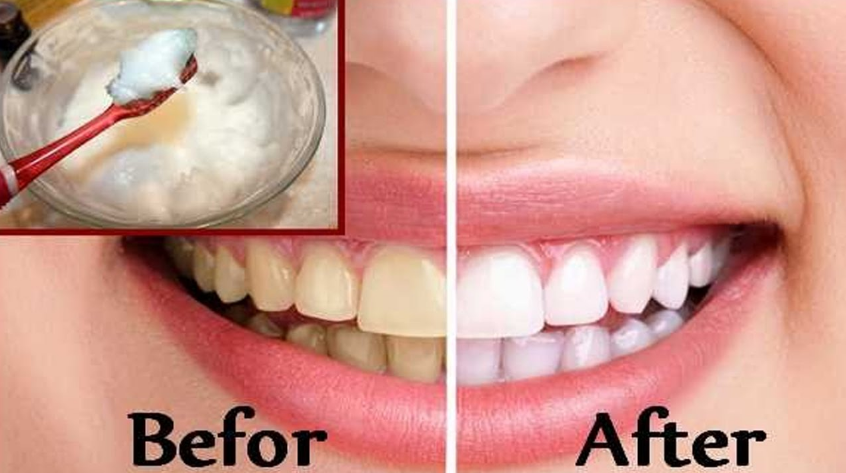 Baking soda teeth whitening results