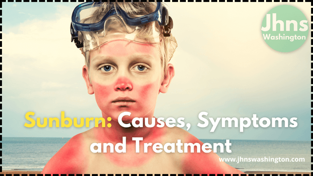 Sunburn: Causes, Symptoms and Treatment