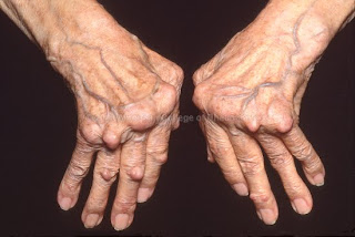 Nursing Care Plan for Rheumatoid Arthritis