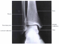 ankle xray