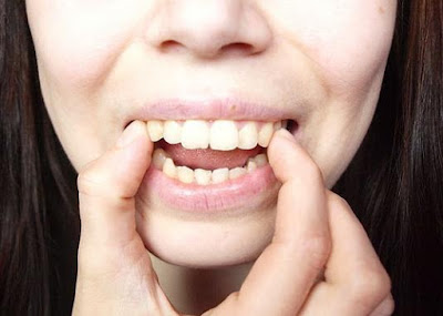 Bọc răng sứ cho răng hô như thế nào?