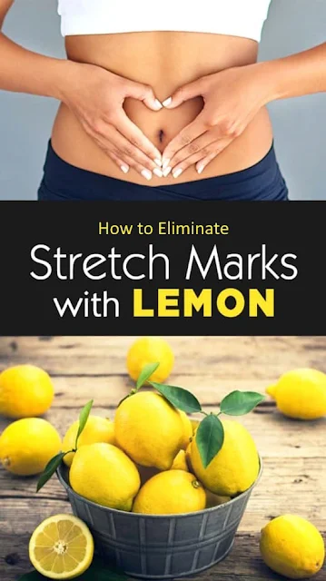 A Lemon-Based Treatment To Eliminate Stretch Marks
