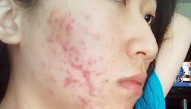 cystic acne