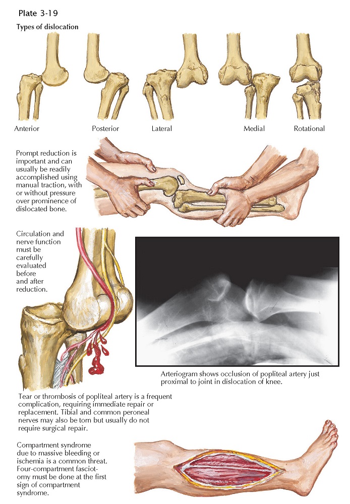 DISLOCATION OF KNEE JOINT