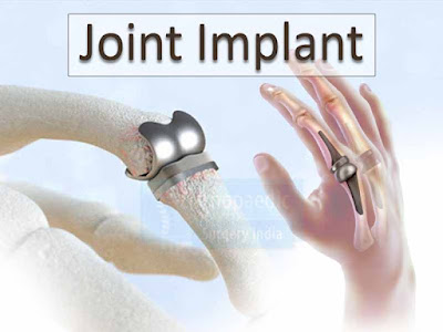 Joint Implant