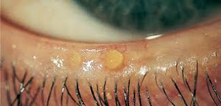 Disturbed Sensory Perception (visual) related to Blepharitis