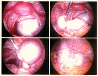 Endometriosis Inflammation