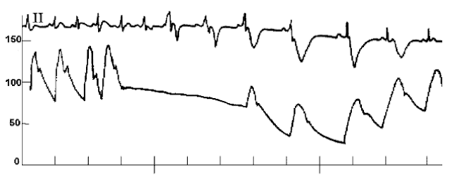 cath data hemodynamic pressure tracing