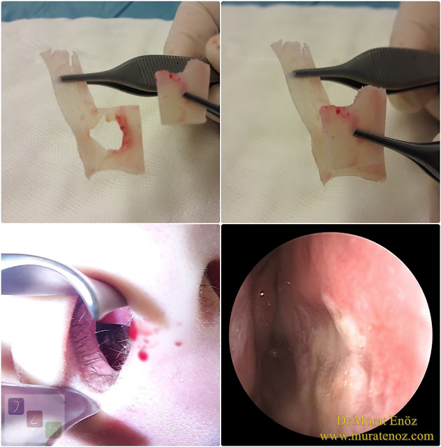 Extracorporeal septum perforation closure in Istanbul - Extracorporeal septum perforation closure in Turkey - Extracorporeal closure of nasal septal perforations subcutaneous tissue - Combining rhinoplasty with extracorporeal septal perforation repair - Repair of nasal septum Perforation