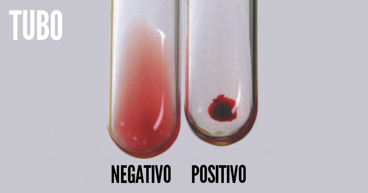 Resultado - aglutinação coombs direto