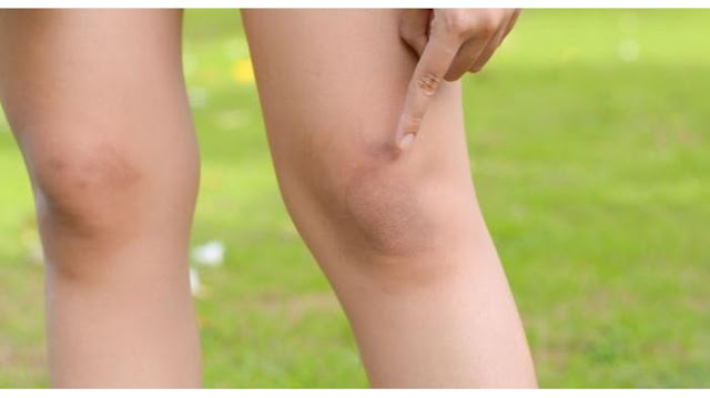 Penyebab Lutut Sakit Di Usia Muda