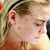 10 Simple Natural Methods to Treat Acne