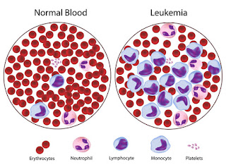 leukemia