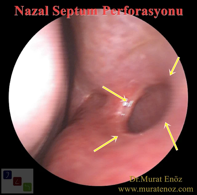 Nazal Septum Perforasyonu